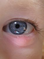 Ячмень на глазу – причины появления и лечение 