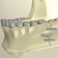 классификация переломов челюстей