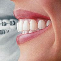 исправление прикуса зубов у взрослых