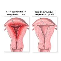 железистая гиперплазия эндометрия