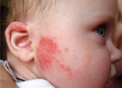 диатез на щеках у ребенка