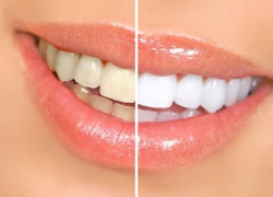 эффективное отбеливание зубов