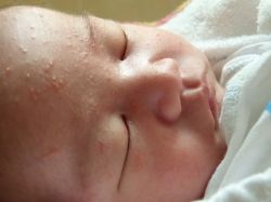 гормональная сыпь у новорожденных