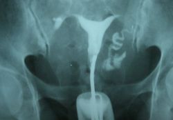 рентген на проходимость маточных труб