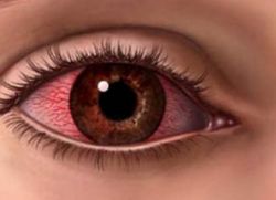 сильное кровоизлияние в глаз