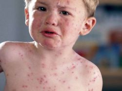 аллергия у ребенка на сладкое