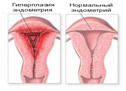 железисто кситозная гиперплазия эндометрия лечение