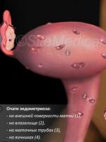Эндометриоз шейки матки - лечение