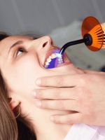 Пломбирование зуба
