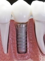 Зубные импланты – «за» и «против»